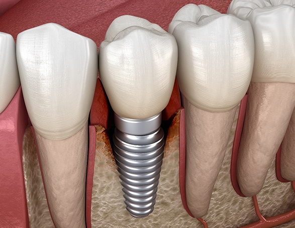Illustration showing infected tissue around a dental implant