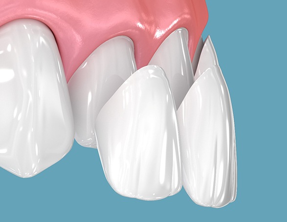 Illustration of dental veneers being placed on teeth